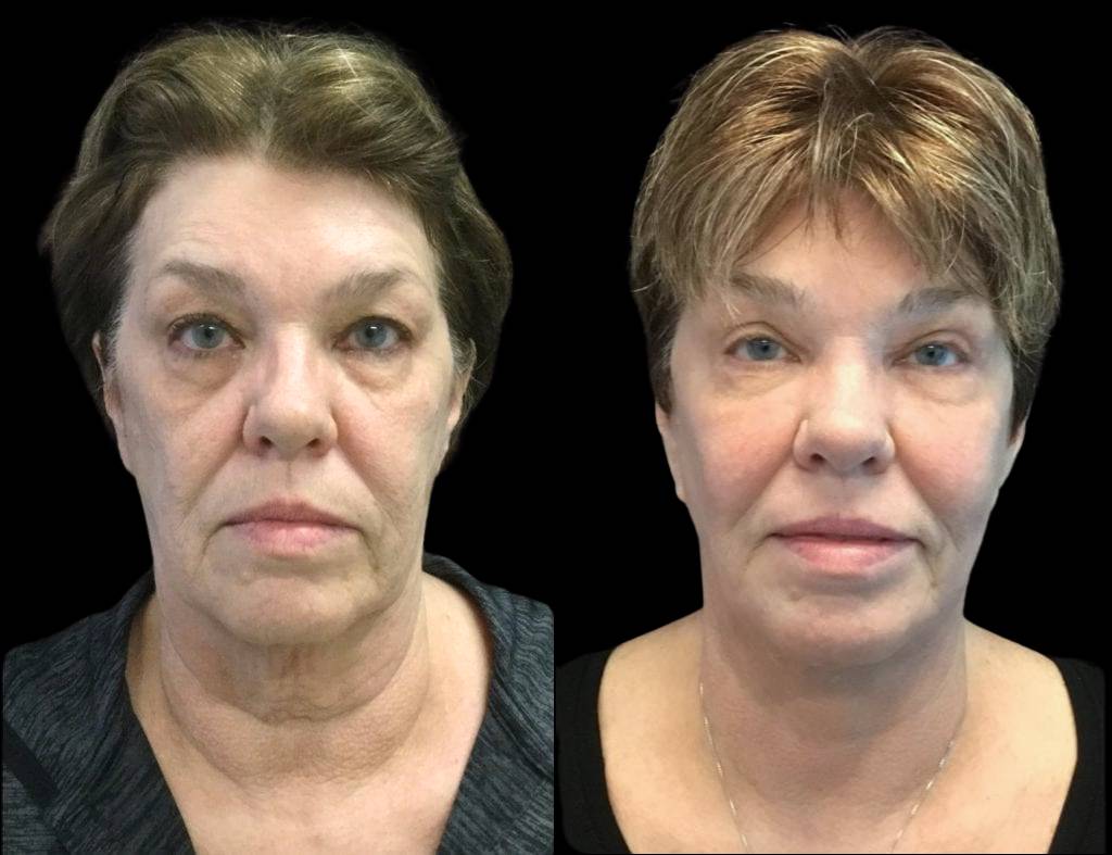 Fractional Laser
