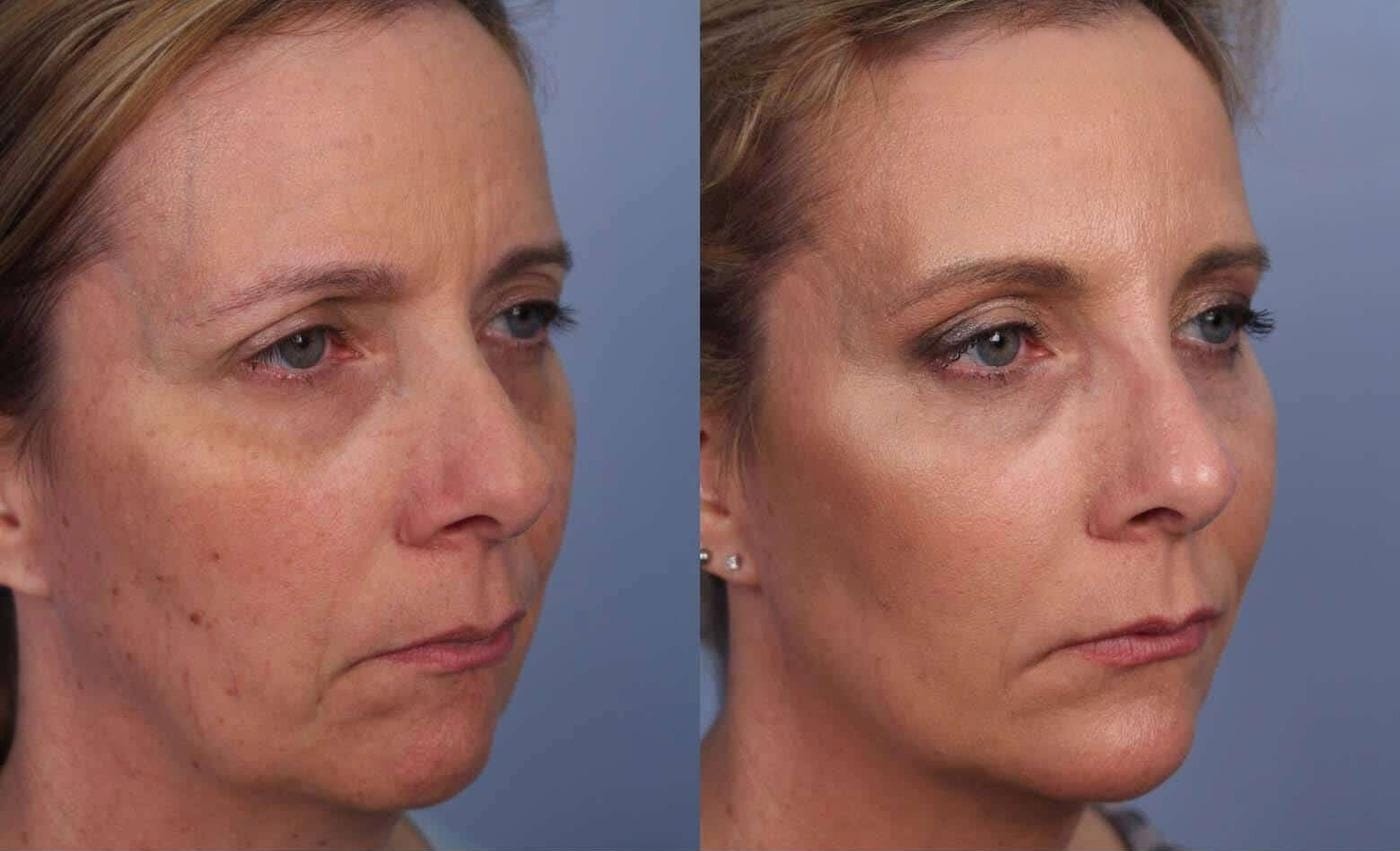 Fractional Laser