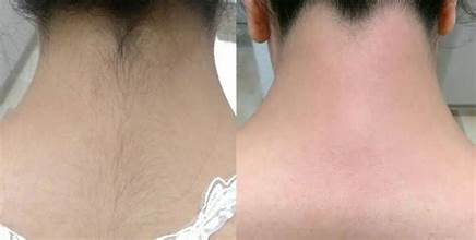 Laser Hair Removal