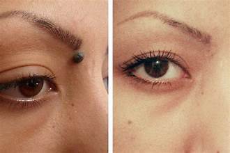 Mole Removal